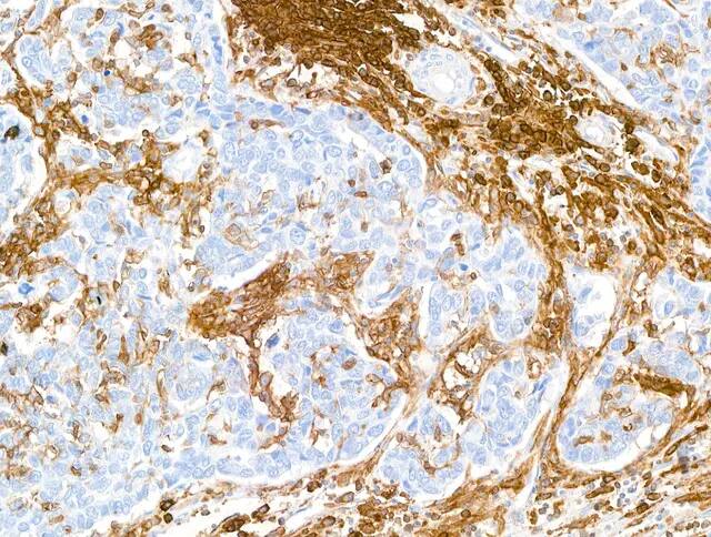 Detection of human CD38 in FFPE breast carcinoma by immunohistochemistry.Antibody: Rabbit anti-CD38 recombinant monoclonal antibody [BLR123H] (NBP3-14707 Lot 1). Secondary: HRP-conjugated goat anti-rabbit IgG . Substrate: DAB.