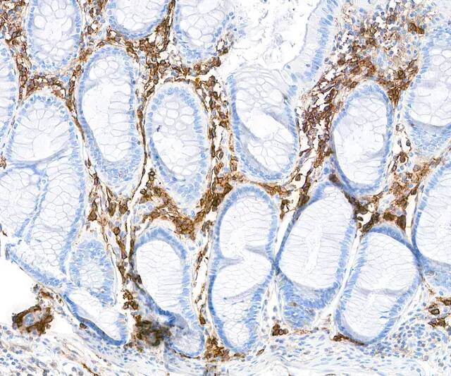 Detection of human CD38 in FFPE colon carcinoma by immunohistochemistry.Antibody: Rabbit anti-CD38 recombinant monoclonal antibody [BLR123H] (NBP3-14707 Lot 1). Secondary: HRP-conjugated goat anti-rabbit IgG . Substrate: DAB.