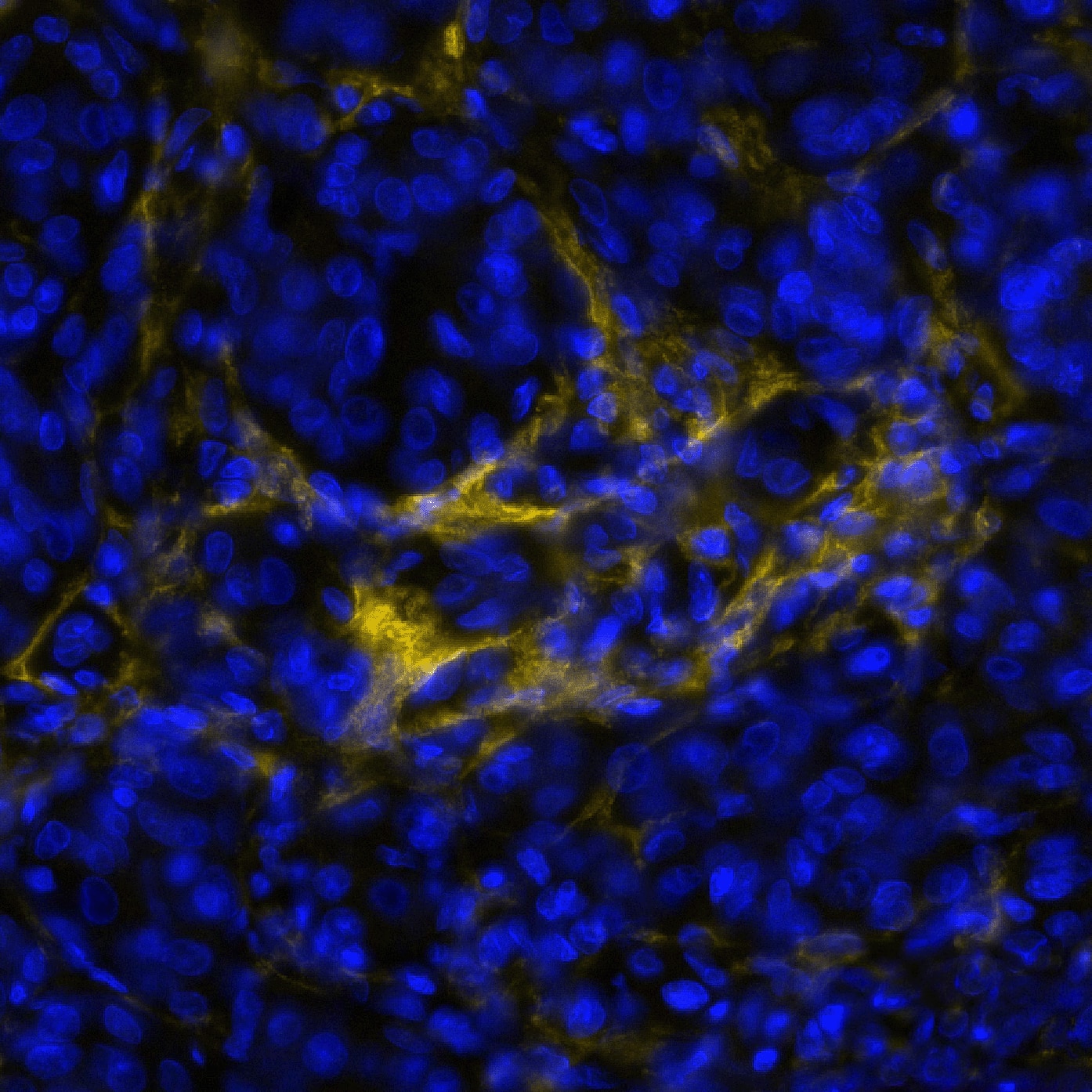 FAP was detected in immersion fixed paraffin-embedded sections of human Melanoma using Rabbit Anti-Human FAP, Monoclonal Antibody (Catalog# NBP3-14728) at 1:100 dilution at 37°Celsius for 4 minutes. Before incubation with the primary antibody, tissue underwent an all-in-one dewaxing and antigen retrieval preprocessing using PreTreatment Module (PT Module) and Dewax and HIER Buffer H (pH 9; Epredia Catalog # TA-999-DHBH). Tissue was stained using the Alexa Fluor™ Plus 647 Goat anti-Rabbit IgG Secondary Antibody at 1:200 at 37 ° Celsius for 2 minutes. (Yellow; Lunaphore Catalog # DR647RB) and counterstained with DAPI (blue; Lunaphore Catalog # DR100). Specific staining was localized to the membrane and cytoplasm of fibroblasts. Protocol available in COMET™ Panel Builder.