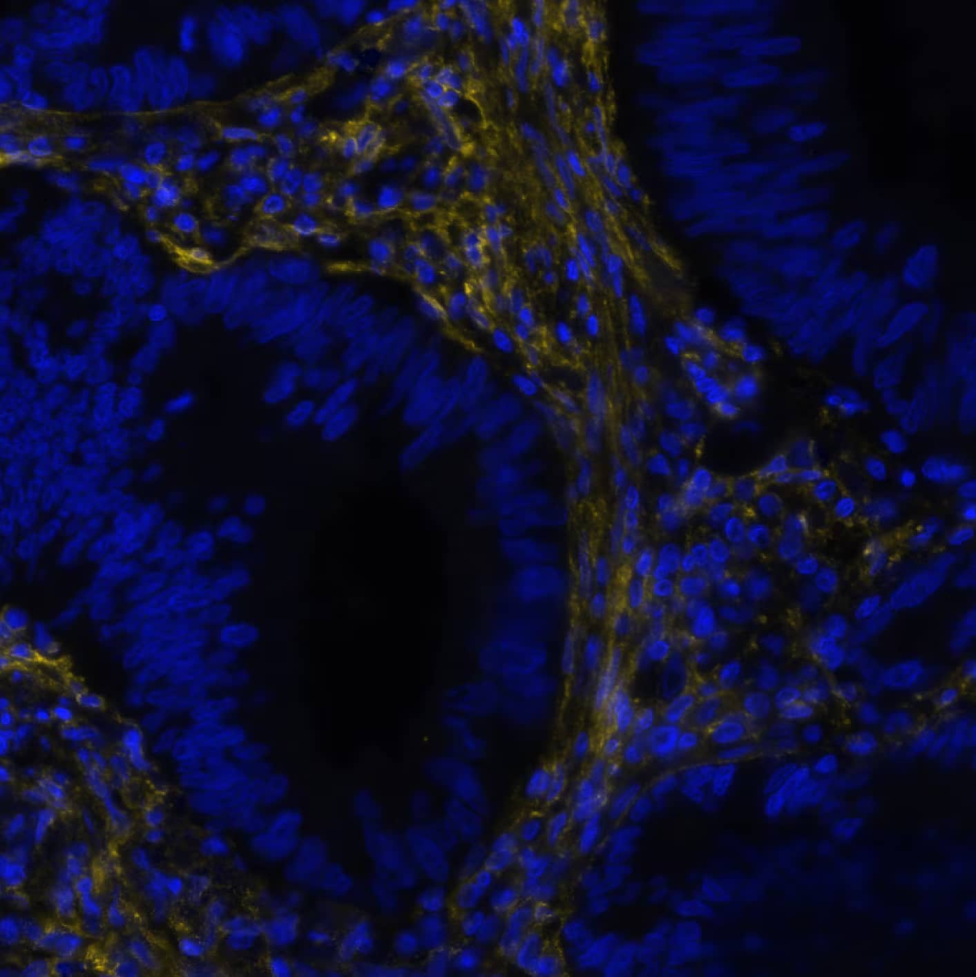 FAP was detected in immersion fixed paraffin-embedded sections of human Colon Cancer using Rabbit Anti-Human FAP, Monoclonal Antibody (Catalog# NBP3-14728) at 1:100 dilution at 37°Celsius for 4 minutes. Before incubation with the primary antibody, tissue underwent an all-in-one dewaxing and antigen retrieval preprocessing using PreTreatment Module (PT Module) and Dewax and HIER Buffer H (pH 9; Epredia Catalog # TA-999-DHBH). Tissue was stained using the Alexa Fluor™ Plus 647 Goat anti-Rabbit IgG Secondary Antibody at 1:200 at 37 ° Celsius for 2 minutes. (Yellow; Lunaphore Catalog # DR647RB) and counterstained with DAPI (blue; Lunaphore Catalog # DR100). Specific staining was localized to the membrane and cytoplasm of fibroblasts. Protocol available in COMET™ Panel Builder.