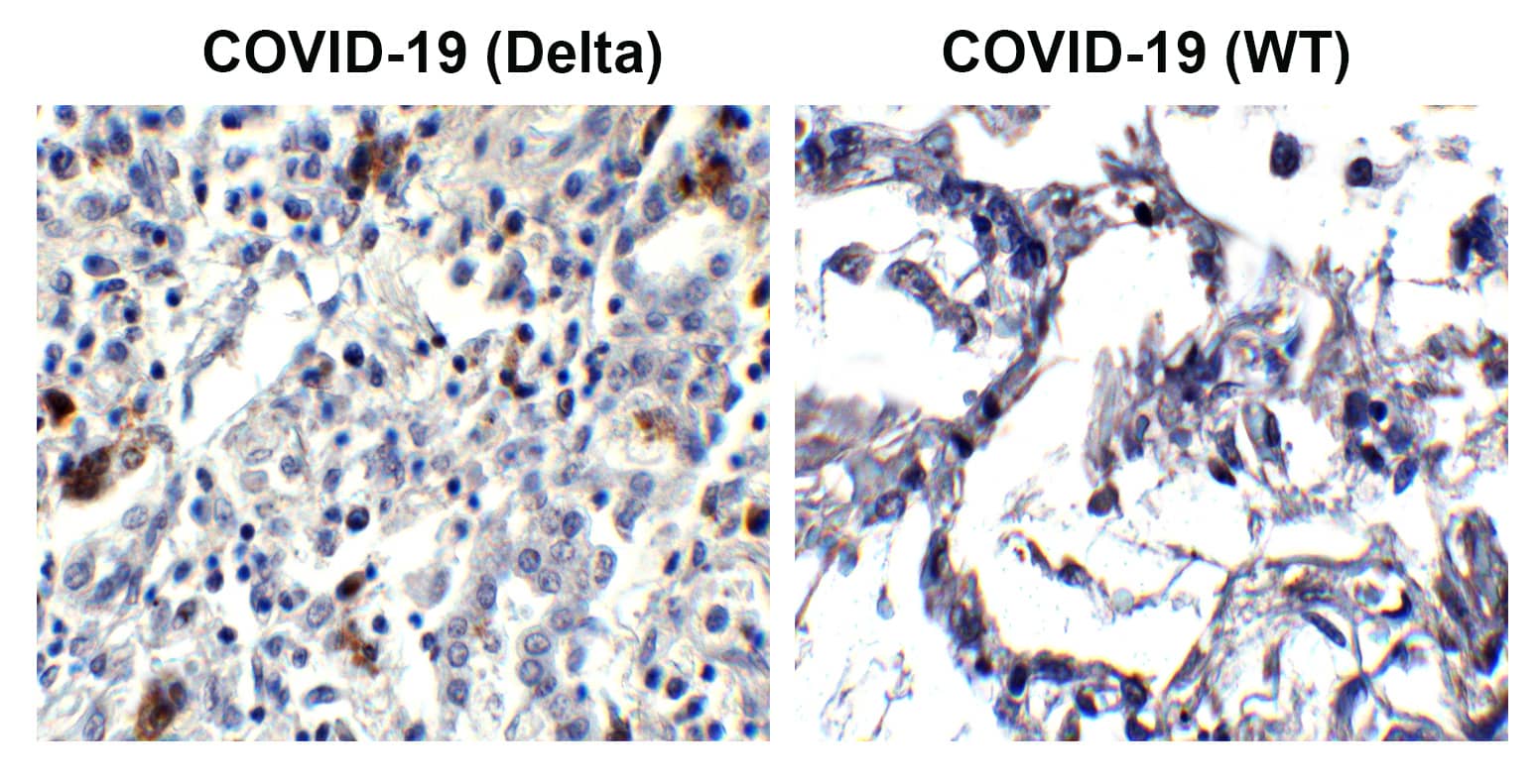 Immunohistochemistry: SARS-CoV-2 Spike Antibody (7E3C5) - Delta Variant, B.1.617.2, India - BSA Free [NBP3-14793] - Figure 1  Immunohistochemistry Validation of Spike in Delta Variant COVID-19 Patient Lung Tissue  Immunohistochemical analysis of paraffin-embedded patient lung tissue using anti-Spike P681R antibody  at 20 u/ml. Tissue was fixed with formaldehyde and blocked with 10% serum for 1 h at RT; antigen retrieval was by heat mediation with a citrate buffer (pH6). Samples were incubated with primary antibody overnight at 4C. A goat anti-rabbit IgG H&L (HRP) at 1/250 was used as secondary. Counter stained with Hematoxylin. Strong spike protein signal was observed in the Delta variant COVID-19 patient lung, but not in WT COVID-19 patient lung. 