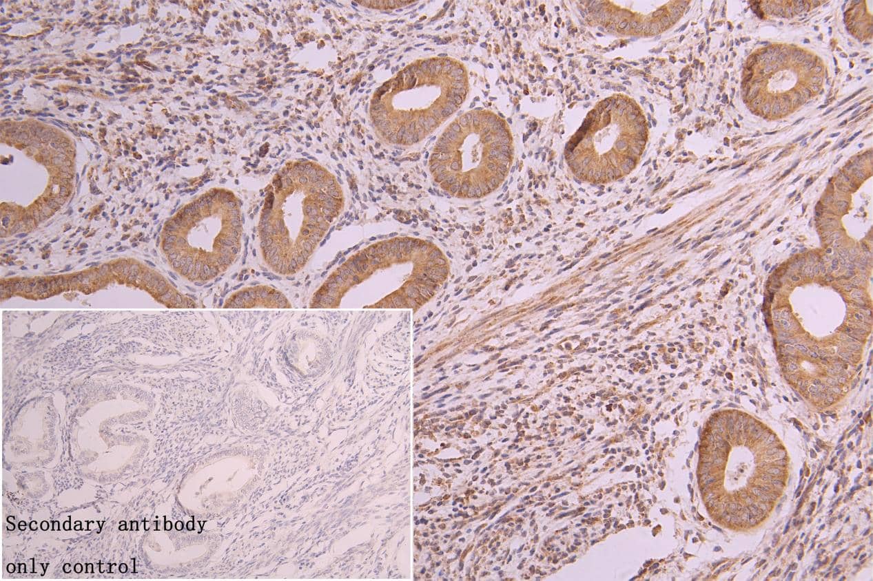 Immunohistochemistry: Rabbit Muscarinic Acetylcholine Receptor M3/CHRM3 mAb (2D4) [NBP3-15165] - Muscarinic Acetylcholine Receptor M3/CHRM3 Antibody diluted at 1:300 and staining in paraffin-embedded human endometrial cancer. After dewaxing and hydration, antigen retrieval was mediated by high pressure in a citrate buffer (pH 6.0). Section was blocked with 10% normal goat serum 30min at RT. Then primary antibody (1% BSA) was incubated at 4°C overnight. The primary is detected by a Goat anti-rabbit polymer IgG labeled by HRP and visualized using 0.05% DAB. Secondary antibody only control: uses 1% BSA instead of primary antibody.