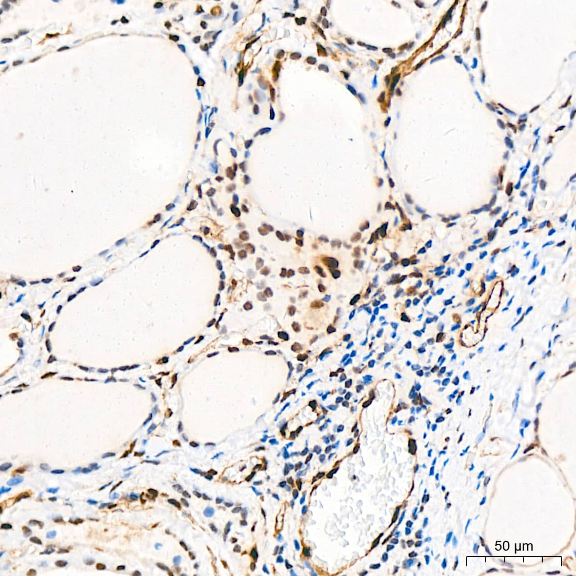 Immunohistochemistry: QKI/Quaking Antibody (1D1N6) [NBP3-15255] - Immunohistochemistry analysis of QKI/Quaking in paraffin-embedded human thyroid tissue using QKI/Quaking Rabbit mAb  at a dilution of 1:200 (40x lens).High pressure antigen retrieval was performed with 0.01 M citrate buffer (pH 6.0) prior to IHC staining.