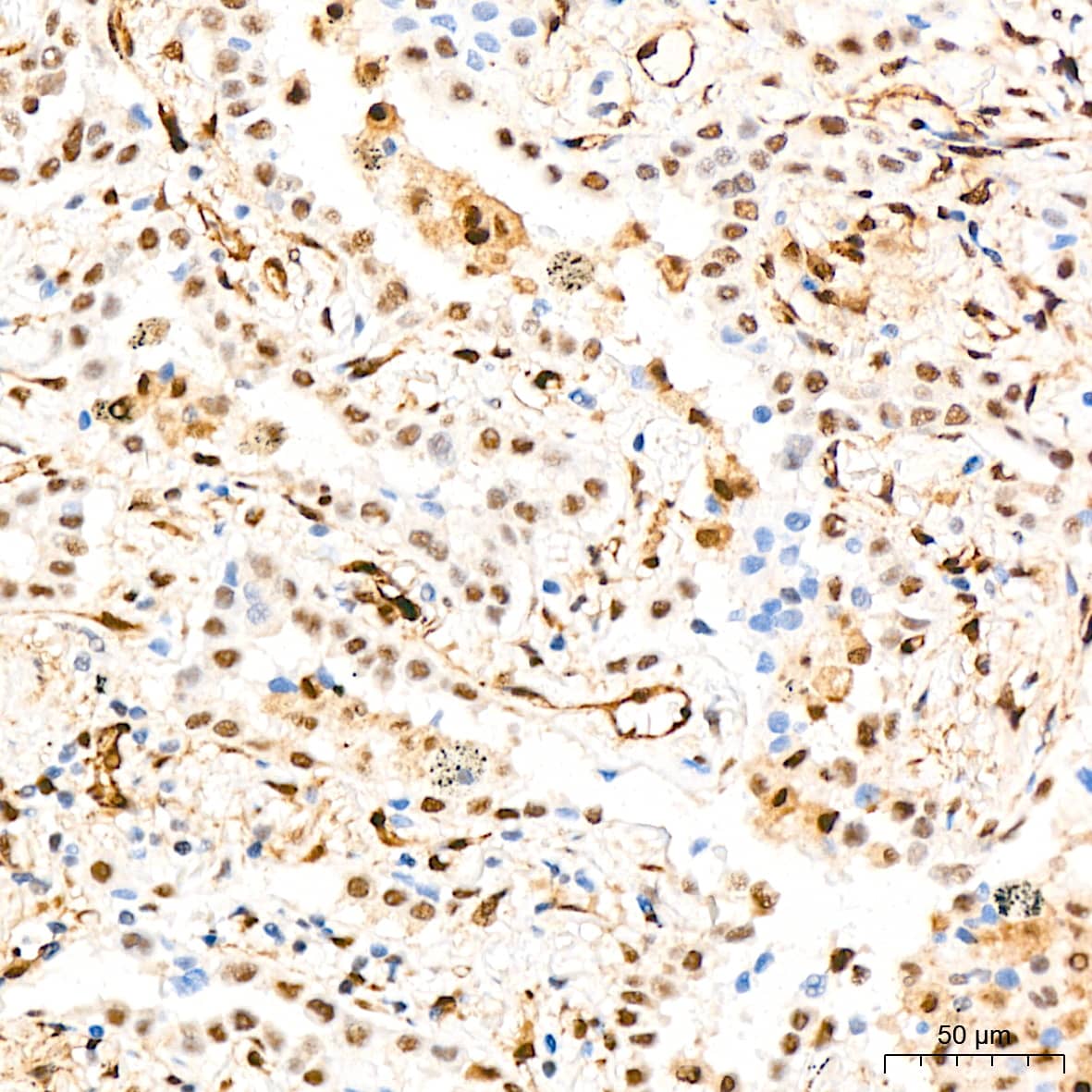 Immunohistochemistry: QKI/Quaking Antibody (1D1N6) [NBP3-15255] - Immunohistochemistry analysis of QKI/Quaking in paraffin-embedded Human lung adenocarcinoma tissue using QKI/Quaking Rabbit mAb  at a dilution of 1:200 (40x lens).High pressure antigen retrieval was performed with 0.01 M citrate buffer (pH 6.0) prior to IHC staining.