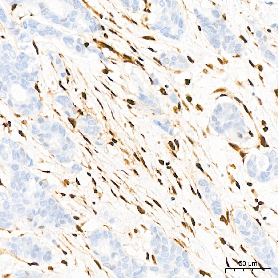 Immunohistochemistry: QKI/Quaking Antibody (1D1N6) [NBP3-15255] - Immunohistochemistry analysis of QKI/Quaking in paraffin-embedded human breast cancer tissue using QKI/Quaking Rabbit mAb  at a dilution of 1:200 (40x lens).High pressure antigen retrieval was performed with 0.01 M citrate buffer (pH 6.0) prior to IHC staining.