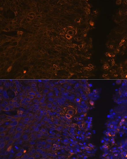 <b>Genetic Strategies Validation. </b>Immunocytochemistry/ Immunofluorescence: Cytokeratin 13 Antibody (5M6B10) [Cytokeratin 13] - Immunofluorescence analysis of paraffin-embedded human cervix cancer using Cytokeratin 13 (KRT13) Rabbit mAb  at dilution of 1:100 (40x lens). Secondary antibody: Cy3-conjugated Goat anti-Rabbit IgG (H+L)  at 1:500 dilution. Blue: DAPI for nuclear staining.