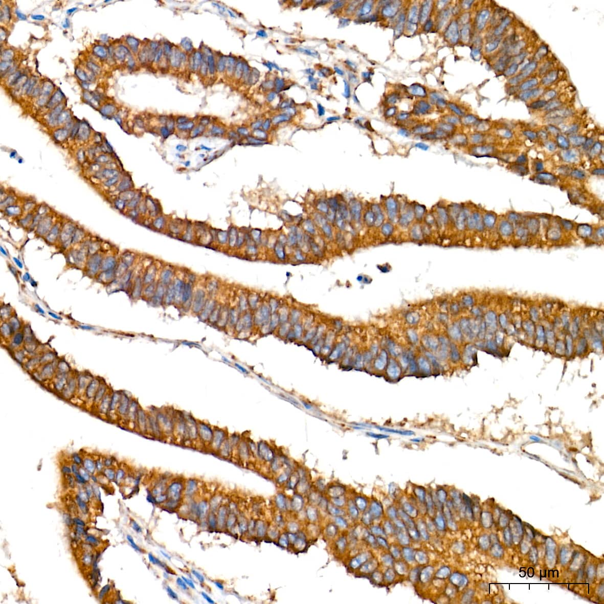 Immunohistochemistry: Alkaline Phosphatase/ALPL Antibody (10B1M5) [Alkaline Phosphatase/ALPL] - Immunohistochemistry analysis of paraffin-embedded Human colon carcinoma tissue using Alkaline Phosphatase/ALPL Rabbit mAb  at a dilution of 1:1000 (40x lens). High pressure antigen retrieval performed with 0.01M Tris-EDTA Buffer (pH 9.0) prior to IHC staining.