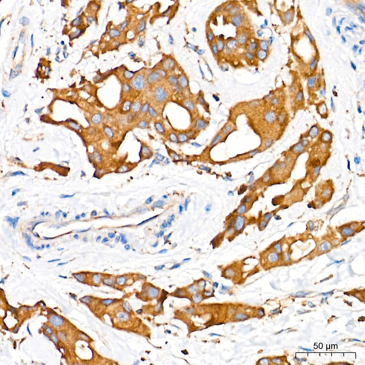 Immunohistochemistry: Alkaline Phosphatase/ALPL Antibody (10B1M5) [Alkaline Phosphatase/ALPL] - Immunohistochemistry analysis of paraffin-embedded Human breast cancer tissue using Alkaline Phosphatase/ALPL Rabbit mAb  at a dilution of 1:1000 (40x lens). High pressure antigen retrieval performed with 0.01M Tris-EDTA Buffer (pH 9.0) prior to IHC staining.