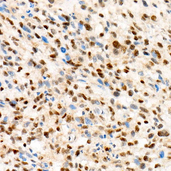 Immunohistochemistry: Transcription factor E3 Antibody (1O9E9) [Transcription factor E3] - Immunohistochemistry analysis of paraffin-embedded Human acinar soft tissue sarcoma using Transcription factor E3 Rabbit mAb  at dilution of  1:100 (40x lens). High pressure antigen retrieval performed with 0.01M Tris/EDTA Buffer (pH 9.0) prior to IHC staining.