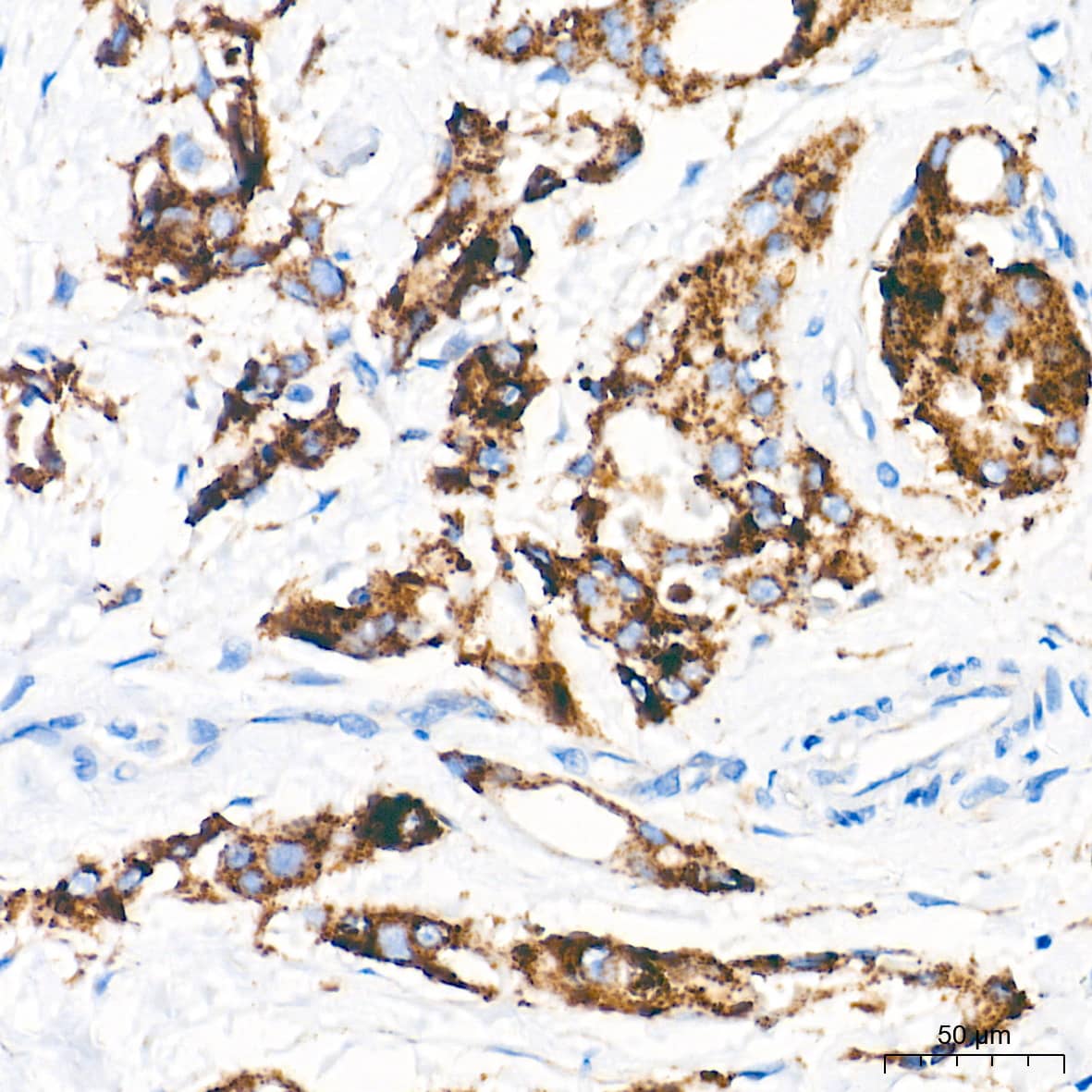 Immunohistochemistry: LAMP-2/CD107b Antibody (5N8J3) [LAMP-2/CD107b] - Immunohistochemistry analysis of paraffin-embedded Human breast cancer tissue using LAMP-2/CD107b Rabbit mAb  at a dilution of 1:2000 (40x lens). High pressure antigen retrieval performed with 0.01M Tris-EDTA Buffer (pH 9.0) prior to IHC staining.