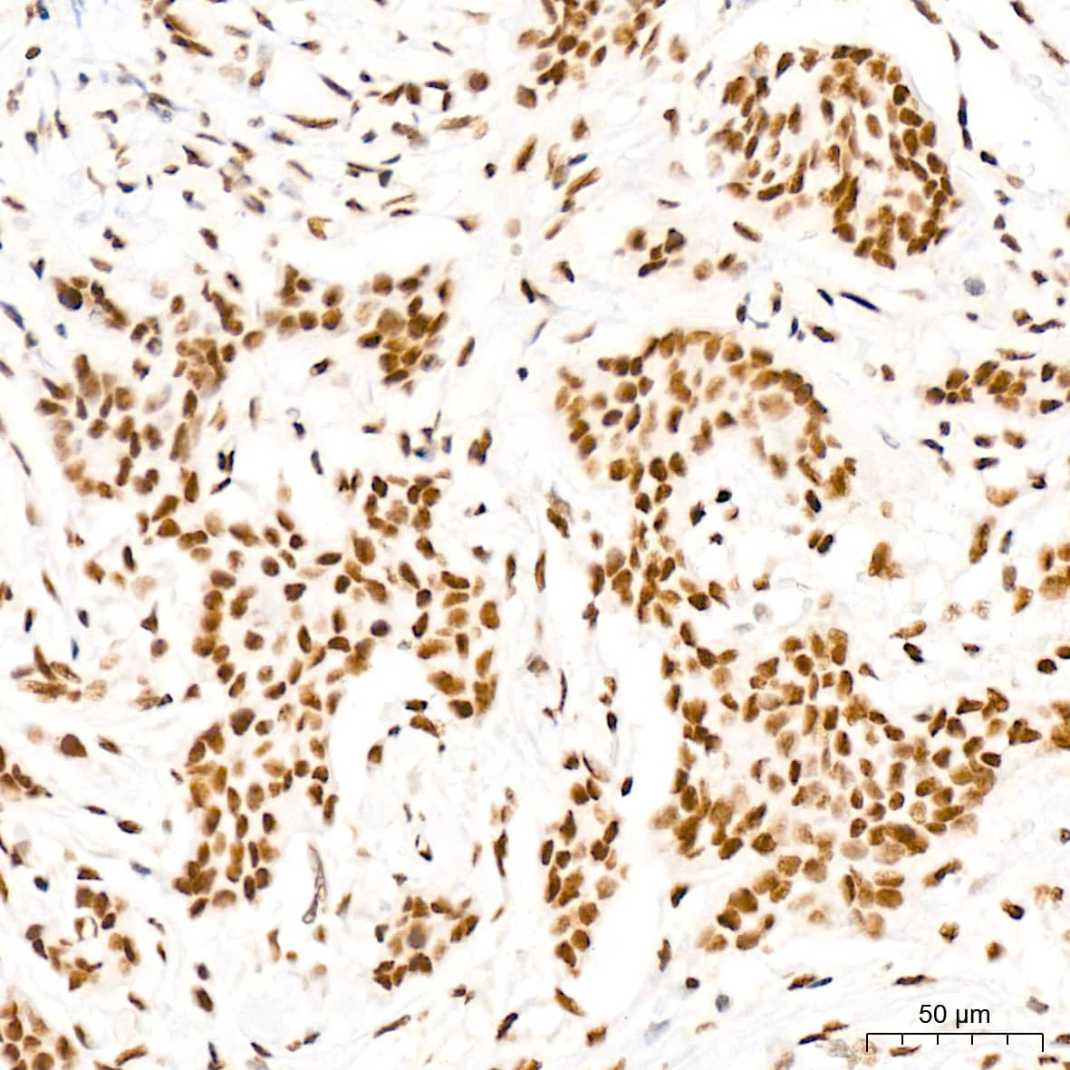 Immunohistochemistry: MED4 Antibody (8T5C9) [NBP3-15287] - Immunohistochemistry analysis of MED4 in paraffin-embedded human breast cancer tissue using MED4 Rabbit mAb  at a dilution of 1:200 (40x lens). High pressure antigen retrieval was performed with 0.01 M citrate buffer (pH 6.0) prior to IHC staining.