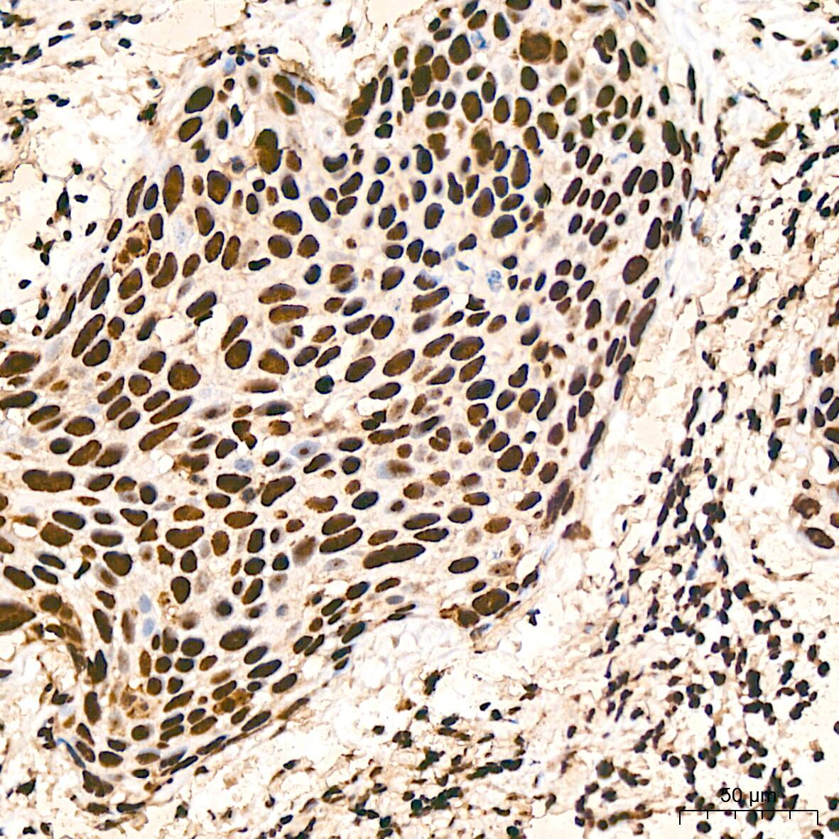 Immunohistochemistry: hnRNP K Antibody (3O5Y4) [NBP3-15303] - Immunohistochemistry analysis of hnRNP K in paraffin-embedded human cervix cancer tissue using hnRNP K Rabbit mAb  at a dilution of 1:800 (40x lens).High pressure antigen retrieval was performed with 0.01 M citrate buffer (pH 6.0) prior to IHC staining.