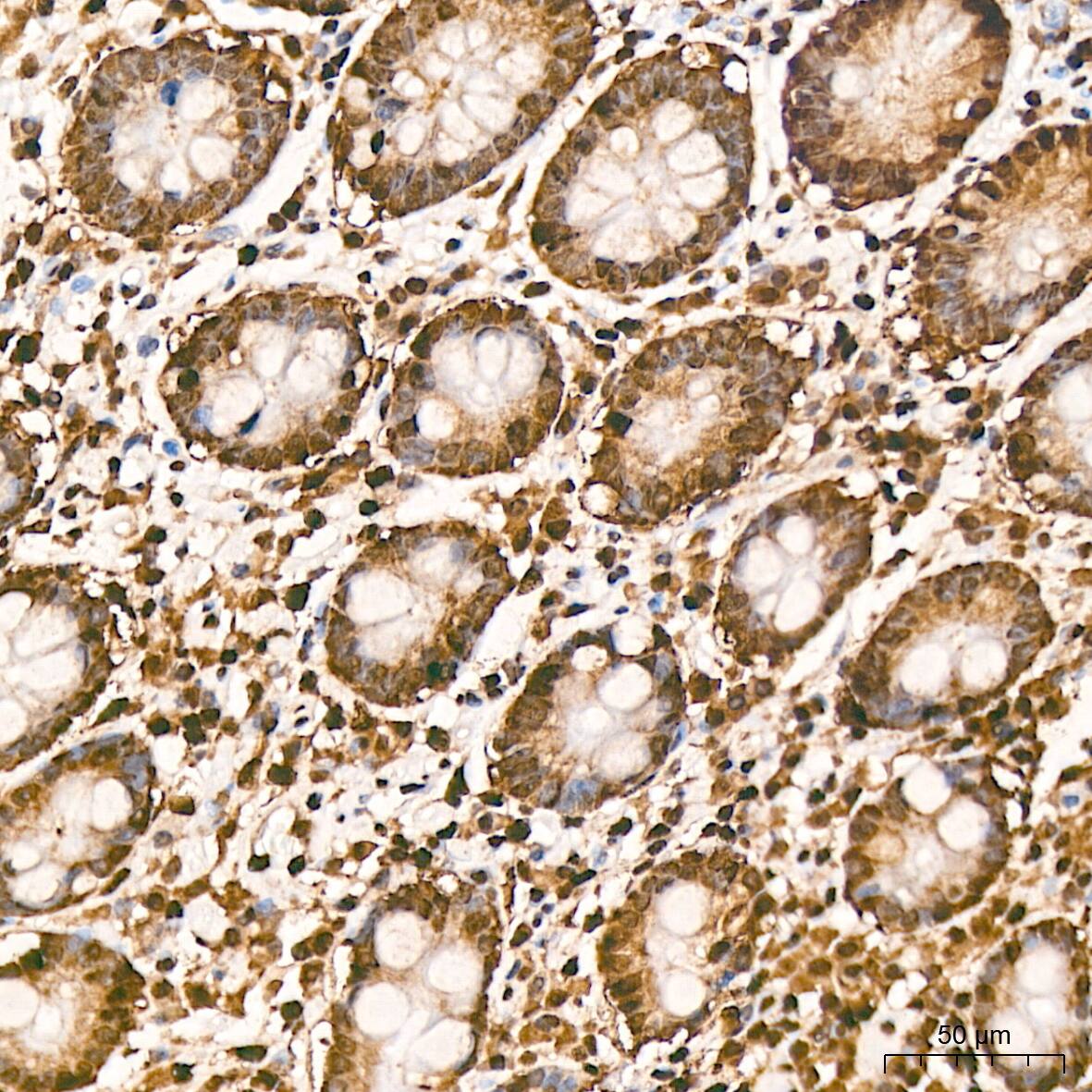 Immunohistochemistry: hnRNP K Antibody (3O5Y4) [NBP3-15303] - Immunohistochemistry analysis of hnRNP K in paraffin-embedded human colon tissue using hnRNP K Rabbit mAb  at a dilution of 1:800 (40x lens).High pressure antigen retrieval was performed with 0.01 M citrate buffer (pH 6.0) prior to IHC staining.