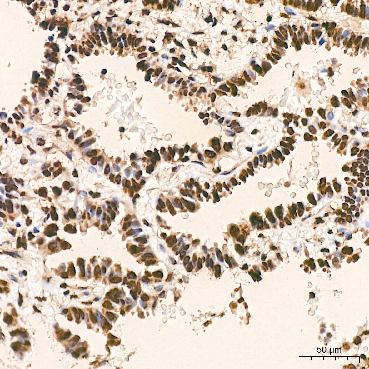 Immunohistochemistry: hnRNP K Antibody (3O5Y4) [NBP3-15303] - Immunohistochemistry analysis of hnRNP K in paraffin-embedded Human lung adenocarcinoma tissue using hnRNP K Rabbit mAb  at a dilution of 1:800 (40x lens).High pressure antigen retrieval was performed with 0.01 M citrate buffer (pH 6.0) prior to IHC staining.