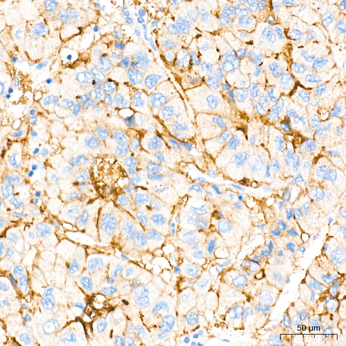 Immunohistochemistry: SR-BI Antibody (1C1I8) [SR-BI] - Immunohistochemistry analysis of paraffin-embedded Human liver cancer tissue using SR-BI Rabbit mAb  at a dilution of 1:1000 (40x lens). High pressure antigen retrieval performed with 0.01M Tris-EDTA Buffer (pH 9.0) prior to IHC staining.