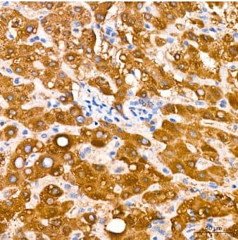 Immunohistochemistry-Paraffin: Microsomal Glutathione S-transferase 1 Antibody (6A0S5) [NBP3-15316] -Human liver cancer tissue using MGST1 Rabbit mAb at a dilution of 1:200 (40x lens). High pressure antigen retrieval performed with 0.01M Citrate Bufferr (pH 6.0) prior to IHC staining.