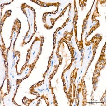 Immunohistochemistry-Paraffin: Microsomal Glutathione S-transferase 1 Antibody (6A0S5) [NBP3-15316] -Human thyroid cancer tissue using MGST1 Rabbit mAb at a dilution of 1:200 (40x lens). High pressure antigen retrieval performed with 0.01M Citrate Bufferr (pH 6.0) prior to IHC staining.