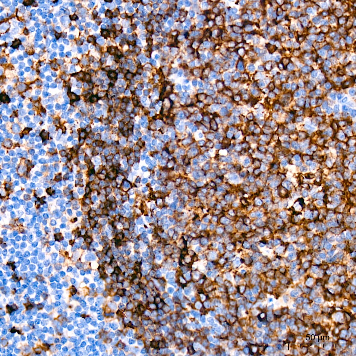 Immunohistochemistry: HLA-DR Antibody (4Y9Y8) [HLA-DR] - Immunohistochemistry analysis of HLA-DR in paraffin-embedded human tonsil tissue using HLA-DR Rabbit mAb  at a dilution of 1:1600 (40x lens). High pressure antigen retrieval was performed with 0.01 M citrate buffer (pH 6.0) prior to IHC staining.