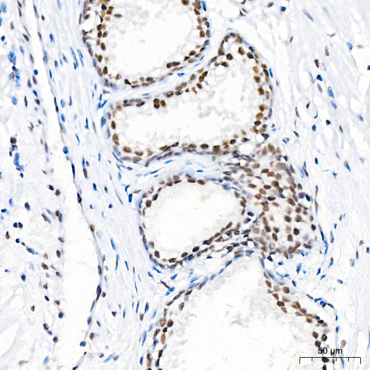 Immunohistochemistry: CDK4 Antibody (6N3M6) [CDK4] - Immunohistochemistry analysis of paraffin-embedded Human prostate tissue using [KO Validated] CDK4 Rabbit mAb  at a dilution of 1:500 (40x lens). High pressure antigen retrieval performed with 0.01M Citrate Bufferr (pH 6.0) prior to IHC staining.