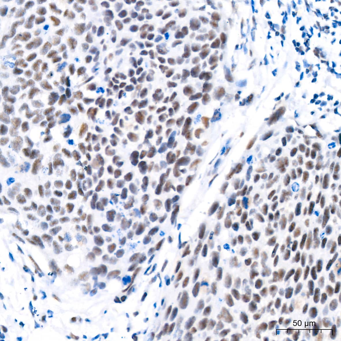 Immunohistochemistry: CDK4 Antibody (6N3M6) [NBP3-15344] - Immunohistochemistry analysis of paraffin-embedded Human cervix cancer tissue using [KO Validated] CDK4 Rabbit mAb  at a dilution of 1:500 (40x lens). High pressure antigen retrieval performed with 0.01M Citrate Bufferr (pH 6.0) prior to IHC staining.