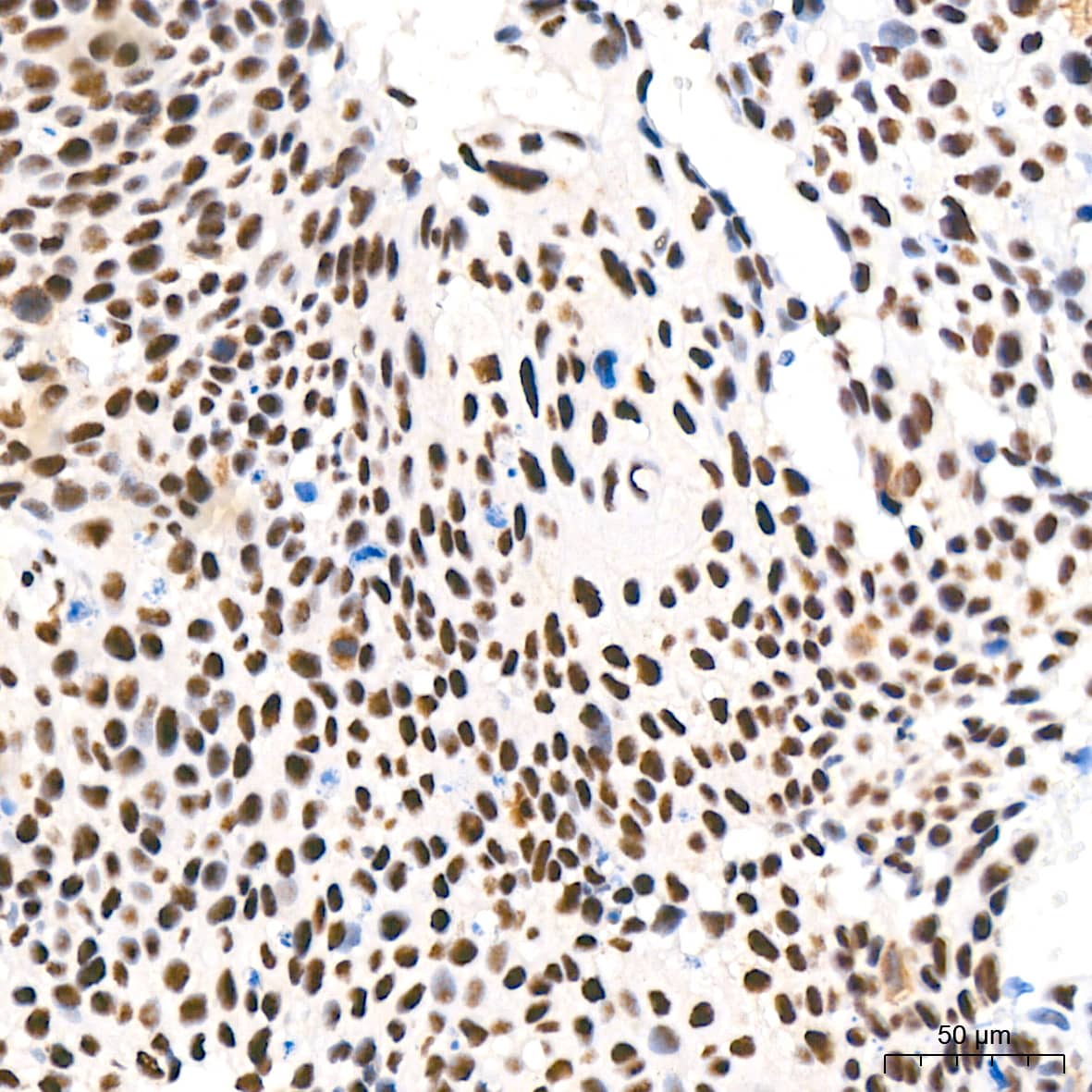 Immunohistochemistry: CDK4 Antibody (6N3M6) [NBP3-15344] - Immunohistochemistry analysis of paraffin-embedded Human cervix cancer tissue using [KO Validated] CDK4 Rabbit mAb  at a dilution of 1:500 (40x lens). High pressure antigen retrieval performed with 0.01M Citrate Bufferr (pH 6.0) prior to IHC staining.