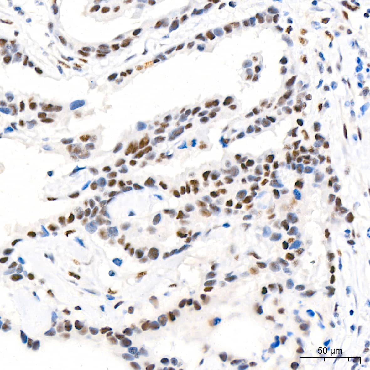 Immunohistochemistry: CDK4 Antibody (6N3M6) [NBP3-15344] - Immunohistochemistry analysis of paraffin-embedded Human breast cancer tissue using [KO Validated] CDK4 Rabbit mAb  at a dilution of 1:500 (40x lens). High pressure antigen retrieval performed with 0.01M Citrate Bufferr (pH 6.0) prior to IHC staining.