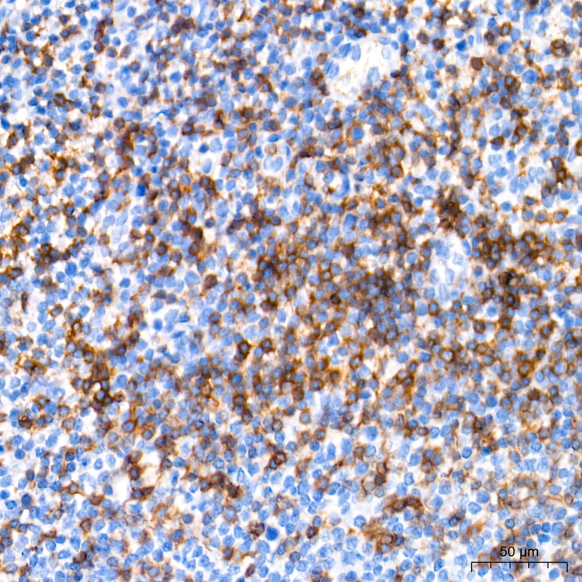 Immunohistochemistry: CD3 zeta Antibody (1T5R7) [CD3 zeta] - Immunohistochemistry analysis of paraffin-embedded Human tonsil tissue using CD3 zeta Rabbit mAb  at a dilution of 1:200 (40x lens). High pressure antigen retrieval performed with 0.01M Tris-EDTA Buffer (pH 9.0) prior to IHC staining.