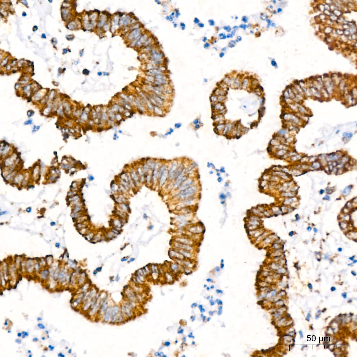 Immunohistochemistry: ATP5A Antibody (6M3B8) [ATP5A] - Immunohistochemistry analysis of paraffin-embedded Human colon carcinoma tissue using ATP5A Rabbit mAb  at dilution of 1:200 (40x lens). High pressure antigen retrieval performed with 0.01M Citrate Bufferr (pH 6.0) prior to IHC staining.