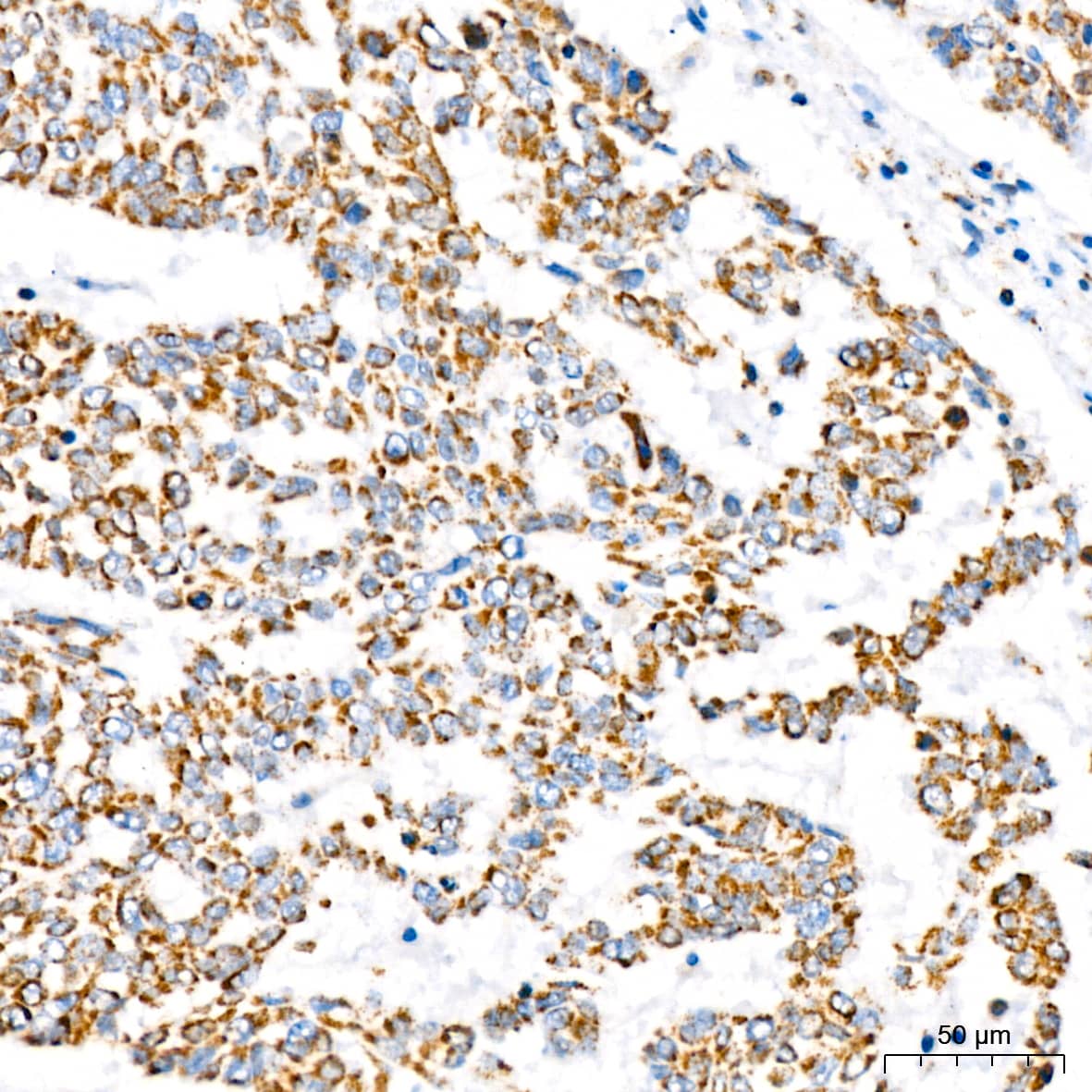 Immunohistochemistry: ATP5A Antibody (6M3B8) [ATP5A] - Immunohistochemistry analysis of paraffin-embedded Human lung squamous carcinoma tissue using ATP5A Rabbit mAb  at dilution of 1:200 (40x lens). High pressure antigen retrieval performed with 0.01M Citrate Bufferr (pH 6.0) prior to IHC staining.