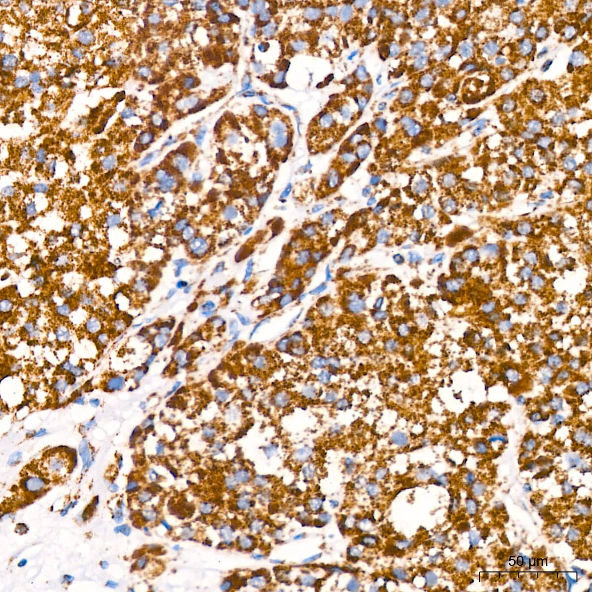 Immunohistochemistry: ATP5A Antibody (6M3B8) [ATP5A] - Immunohistochemistry analysis of paraffin-embedded Human liver cancer tissue using ATP5A Rabbit mAb  at dilution of 1:200 (40x lens). High pressure antigen retrieval performed with 0.01M Citrate Bufferr (pH 6.0) prior to IHC staining.