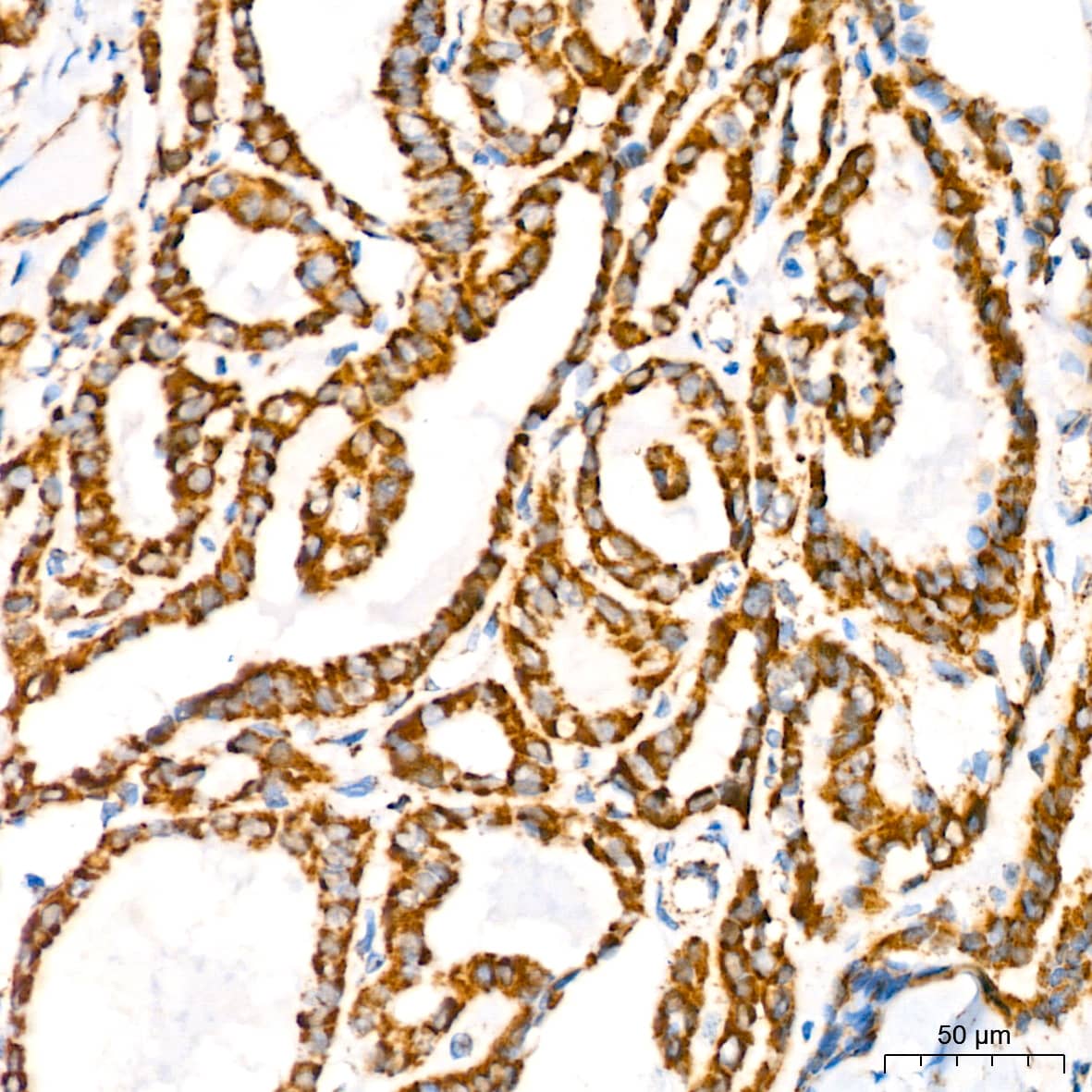 Immunohistochemistry: ATP5A Antibody (6M3B8) [ATP5A] - Immunohistochemistry analysis of paraffin-embedded Human thyroid cancer tissue using ATP5A Rabbit mAb  at dilution of 1:200 (40x lens). High pressure antigen retrieval performed with 0.01M Citrate Bufferr (pH 6.0) prior to IHC staining.