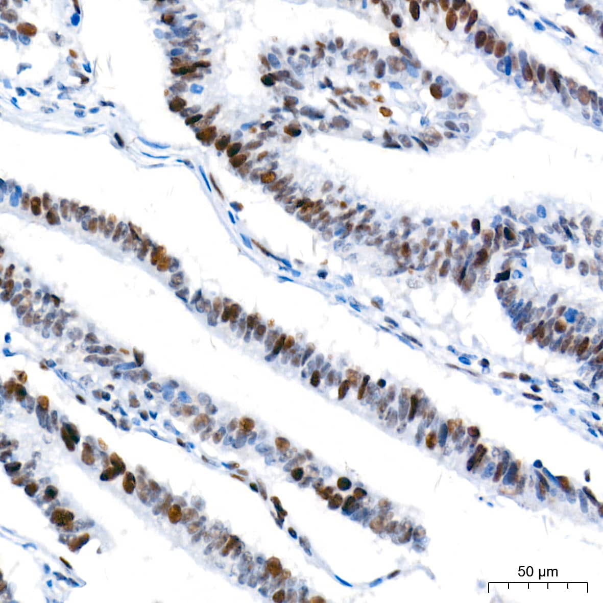 Immunohistochemistry: Ku70/XRCC6 Antibody (8L6B6) [Ku70/XRCC6] - Immunohistochemistry analysis of paraffin-embedded Human colon carcinoma tissue using Ku70/XRCC6 Rabbit mAb  at a dilution of 1:500 (40x lens). High pressure antigen retrieval performed with 0.01M Tris-EDTA Buffer (pH 9.0) prior to IHC staining.