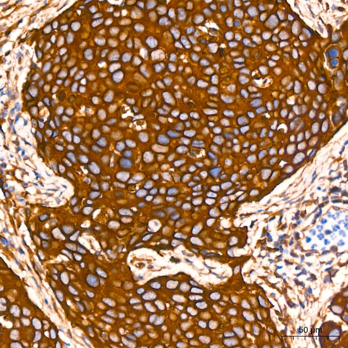 Immunohistochemistry: Annexin A2 Antibody (1W2B5) [Annexin A2] - Immunohistochemistry analysis of paraffin-embedded Human cervix cancer tissue using Annexin A2 Rabbit mAb  at a dilution of 1:800 (40x lens). High pressure antigen retrieval performed with 0.01M Citrate Bufferr (pH 6.0) prior to IHC staining.