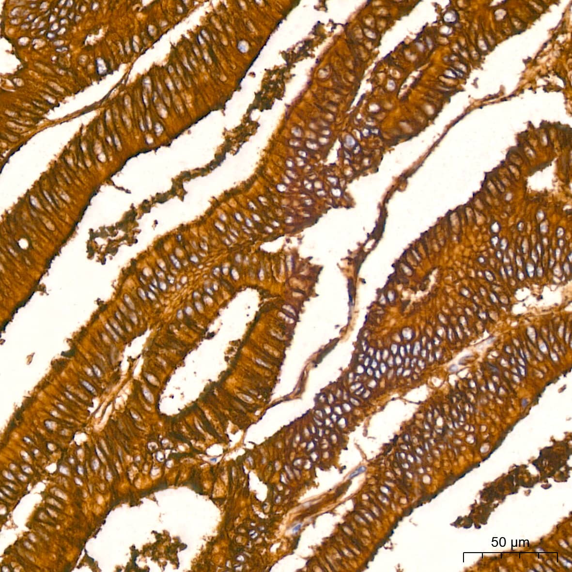 Immunohistochemistry: Annexin A2 Antibody (1W2B5) [Annexin A2] - Immunohistochemistry analysis of paraffin-embedded Human colon carcinoma tissue using Annexin A2 Rabbit mAb  at a dilution of 1:800 (40x lens). High pressure antigen retrieval performed with 0.01M Citrate Bufferr (pH 6.0) prior to IHC staining.