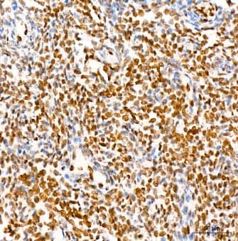 Immunohistochemistry-Paraffin: FGF basic/FGF2/bFGF Antibody (8W6M5) [NBP3-15367] -Analysis of FGF2 in paraffin-embedded human lung squamous carcinoma tissue using FGF2 Rabbit mAb at dilution of 1:400 (40x lens).Perform high pressure antigen retrieval with 10 mM Tris/EDTA buffer pH 9.0 before commencing with IHC staining protocol.