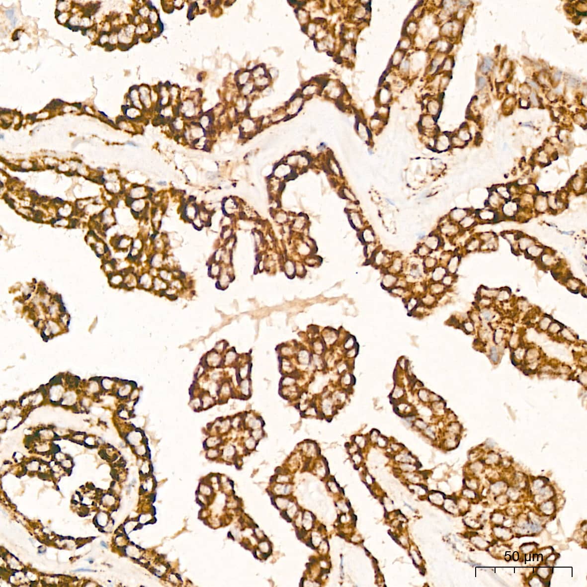 Immunohistochemistry: HABP1/C1QBP/GC1q R Antibody (6N7U3) [NBP3-15368] - Immunohistochemistry analysis of HABP1/C1QBP/GC1q R in paraffin-embedded human thyroid cancer tissue using HABP1/C1QBP/GC1q R Rabbit mAb  at a dilution of 1:200 (40x lens). High pressure antigen retrieval was performed with 0.01 M citrate buffer (pH 6.0) prior to IHC staining.