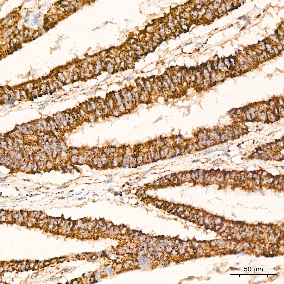 Immunohistochemistry: HABP1/C1QBP/GC1q R Antibody (6N7U3) [NBP3-15368] - Immunohistochemistry analysis of HABP1/C1QBP/GC1q R in paraffin-embedded human colon carcinoma tissue using HABP1/C1QBP/GC1q R Rabbit mAb  at a dilution of 1:200 (40x lens). High pressure antigen retrieval was performed with 0.01 M citrate buffer (pH 6.0) prior to IHC staining.