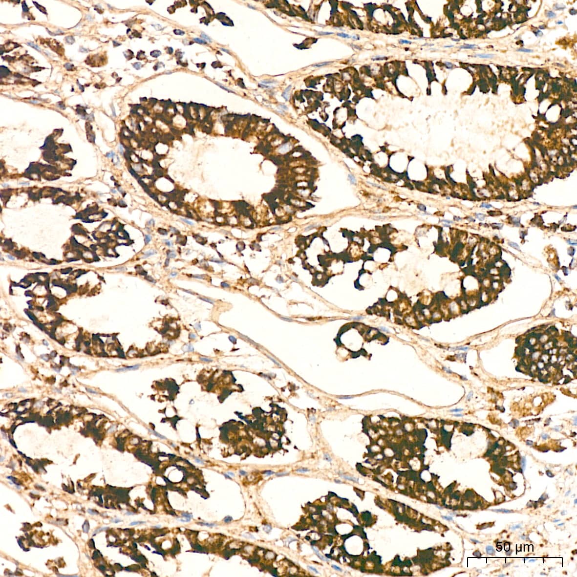 Immunohistochemistry: HABP1/C1QBP/GC1q R Antibody (6N7U3) [NBP3-15368] - Immunohistochemistry analysis of HABP1/C1QBP/GC1q R in paraffin-embedded human colon tissue using HABP1/C1QBP/GC1q R Rabbit mAb  at a dilution of 1:200 (40x lens). High pressure antigen retrieval was performed with 0.01 M citrate buffer (pH 6.0) prior to IHC staining.