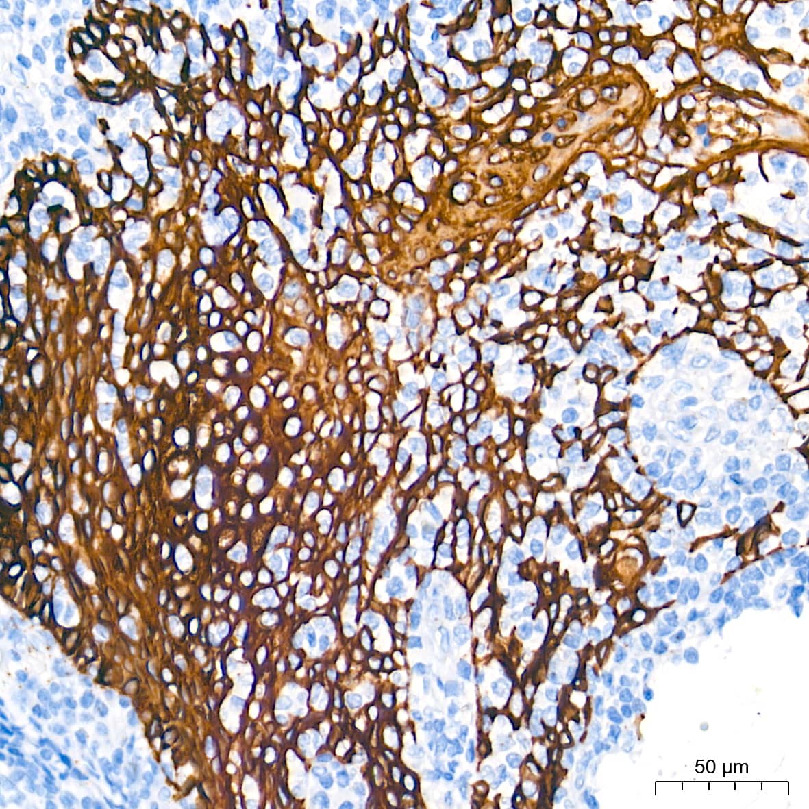 Immunohistochemistry: Cytokeratin 5 Antibody (3P3T9) [Cytokeratin 5] - Immunohistochemistry analysis of paraffin-embedded Human tonsil tissue using Cytokeratin 5 Rabbit mAb  at a dilution of 1:2000 (40x lens). High pressure antigen retrieval performed with 0.01M Tris-EDTA Buffer (pH 9.0) prior to IHC staining.