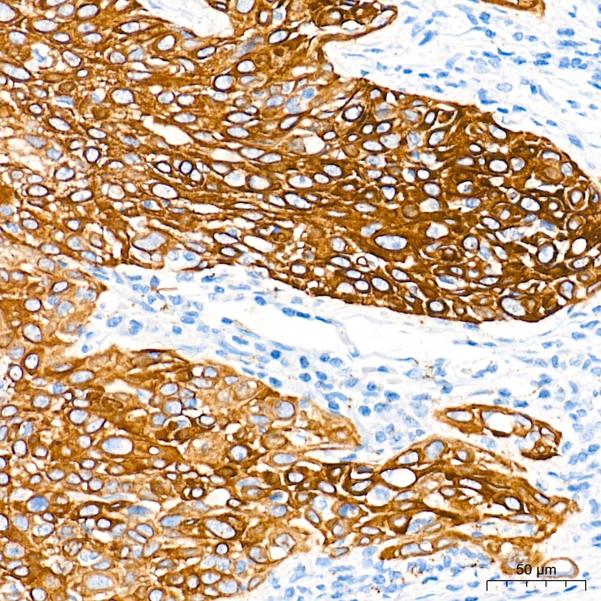 Immunohistochemistry: Cytokeratin 5 Antibody (3P3T9) [Cytokeratin 5] - Immunohistochemistry analysis of paraffin-embedded Human cervix cancer tissue using Cytokeratin 5 Rabbit mAb  at a dilution of 1:2000 (40x lens). High pressure antigen retrieval performed with 0.01M Tris-EDTA Buffer (pH 9.0) prior to IHC staining.