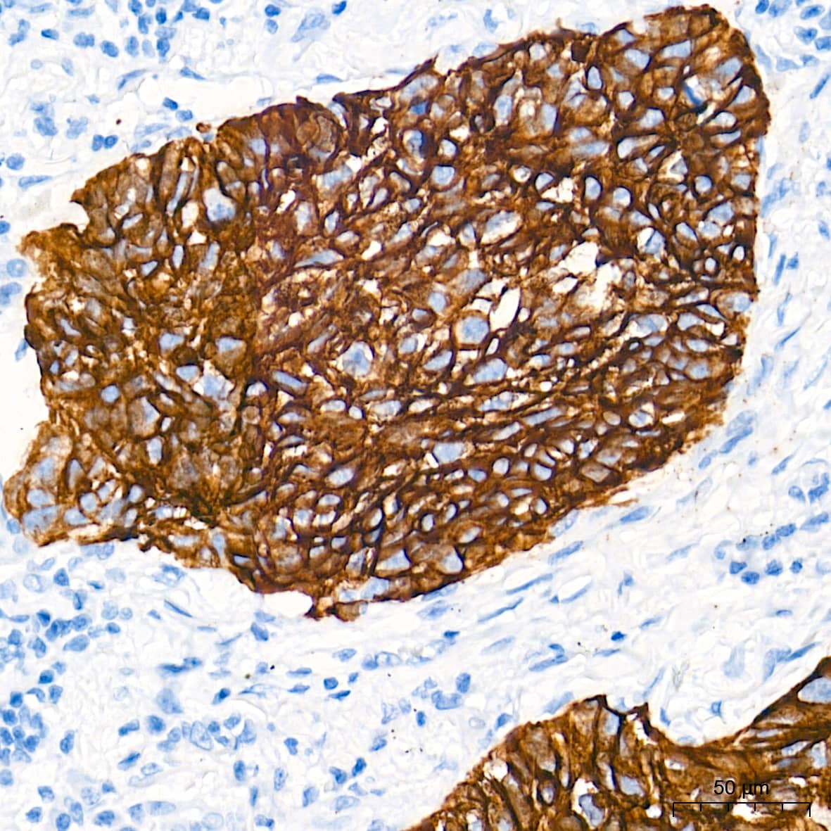 Immunohistochemistry: Cytokeratin 5 Antibody (3P3T9) [Cytokeratin 5] - Immunohistochemistry analysis of paraffin-embedded Human lung squamous carcinoma tissue using Cytokeratin 5 Rabbit mAb  at a dilution of 1:2000 (40x lens). High pressure antigen retrieval performed with 0.01M Tris-EDTA Buffer (pH 9.0) prior to IHC staining.