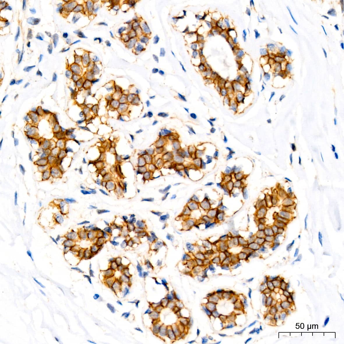 Immunohistochemistry: p120-catenin Antibody (5N7Z0) [p120-catenin] - Immunohistochemistry analysis of paraffin-embedded Human breast using p120-catenin Rabbit mAb  at dilution of 1:100 (40x lens). High pressure antigen retrieval performed with 0.01M Tris/EDTA Buffer (pH 9.0) prior to IHC staining.