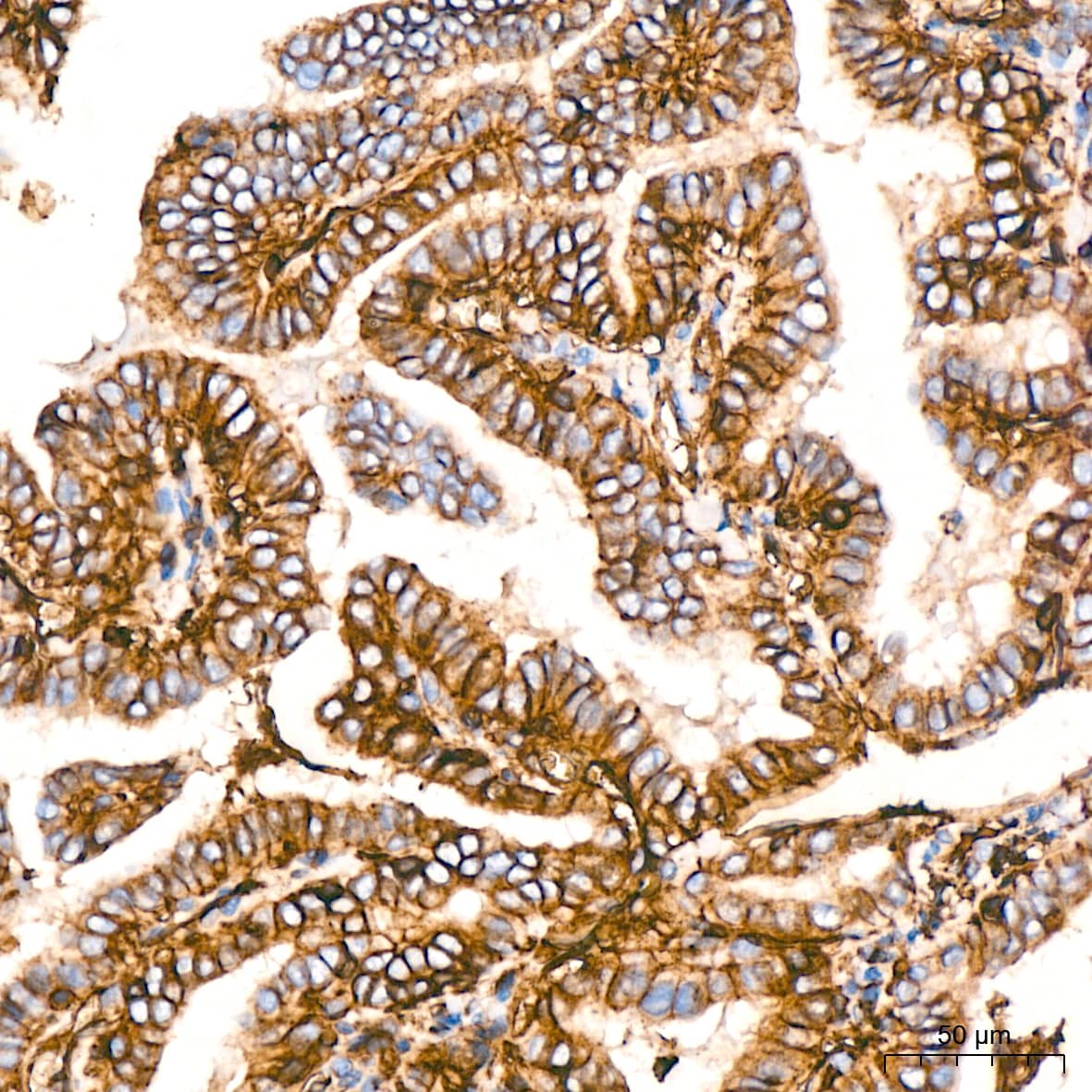 Immunohistochemistry: HLA A Antibody (8L2H2) [HLA A] - Immunohistochemistry analysis of paraffin-embedded Human thyroid cancer tissue using HLA A Rabbit mAb  at a dilution of 1:200 (40x lens). High pressure antigen retrieval was performed with 0.01 M citrate buffer (pH 6.0) prior to IHC staining.