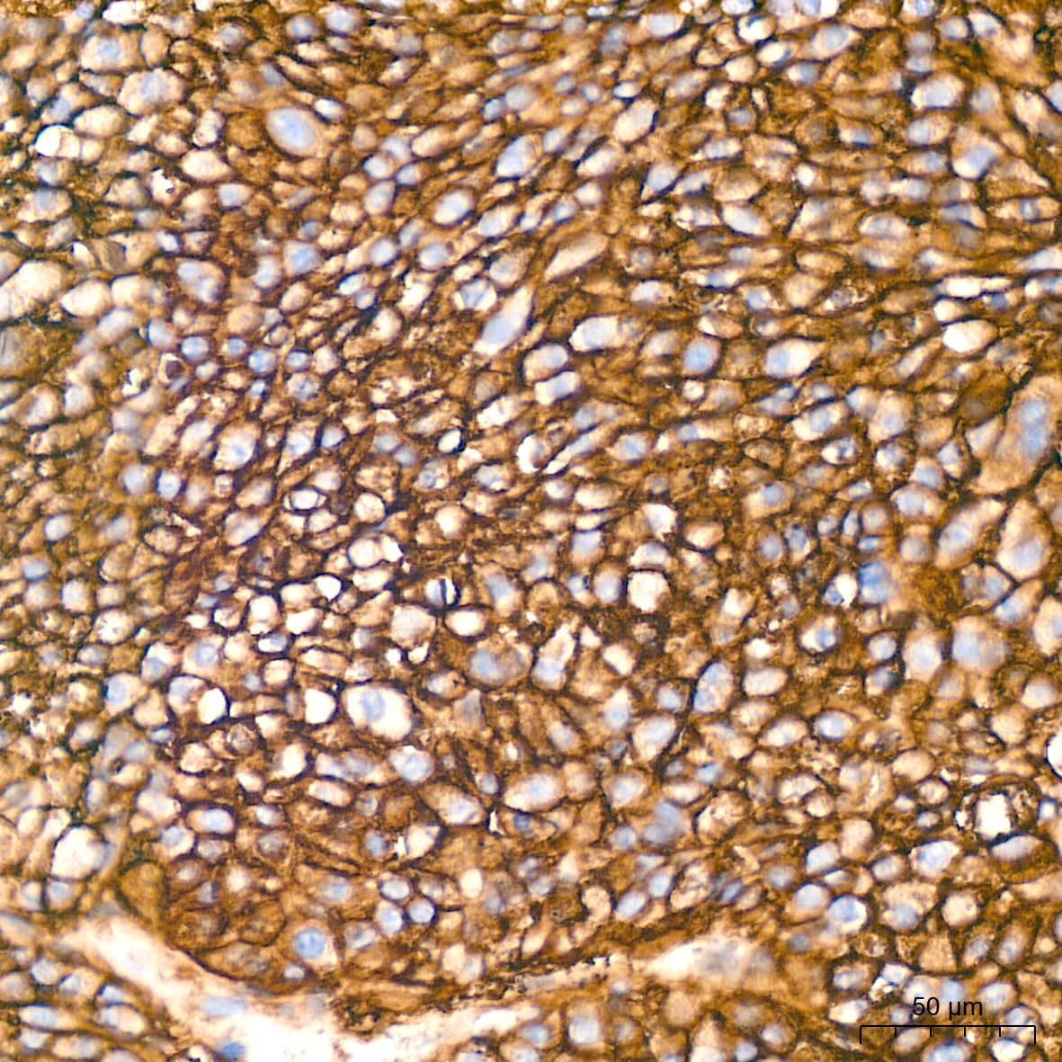 Immunohistochemistry: HLA A Antibody (8L2H2) [HLA A] - Immunohistochemistry analysis of paraffin-embedded Human liver cancer tissue using HLA A Rabbit mAb  at a dilution of 1:200 (40x lens). High pressure antigen retrieval was performed with 0.01 M citrate buffer (pH 6.0) prior to IHC staining.