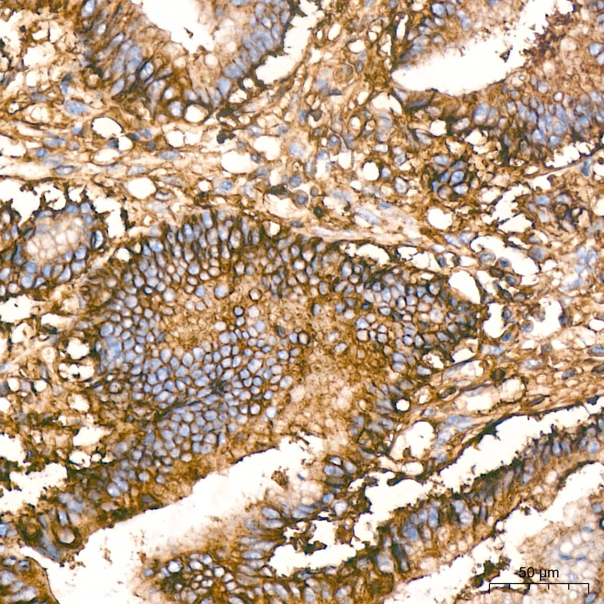 Immunohistochemistry: HLA A Antibody (8L2H2) [HLA A] - Immunohistochemistry analysis of paraffin-embedded Human colon carcinoma tissue using HLA A Rabbit mAb  at a dilution of 1:200 (40x lens). High pressure antigen retrieval was performed with 0.01 M citrate buffer (pH 6.0) prior to IHC staining.