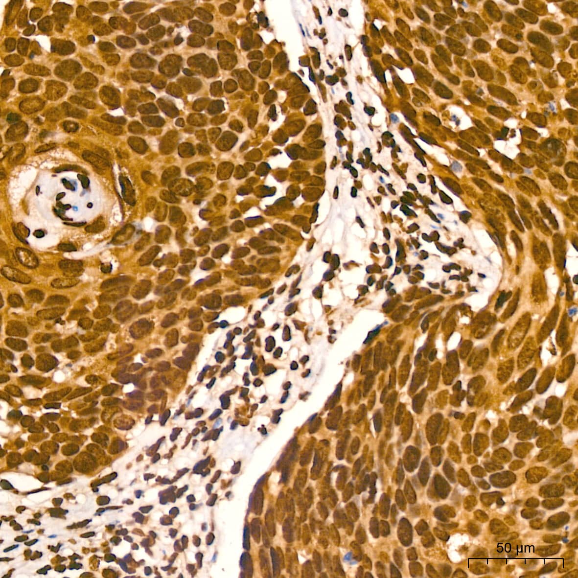 Immunohistochemistry: Histone H2AX Antibody (4Z3S8) [Histone H2AX] - Immunohistochemistry analysis of paraffin-embedded Human cervix cancer tissue using Histone H2AX Rabbit mAb  at a dilution of 1:800 (40x lens). High pressure antigen retrieval performed with 0.01M Citrate Bufferr (pH 6.0) prior to IHC staining.