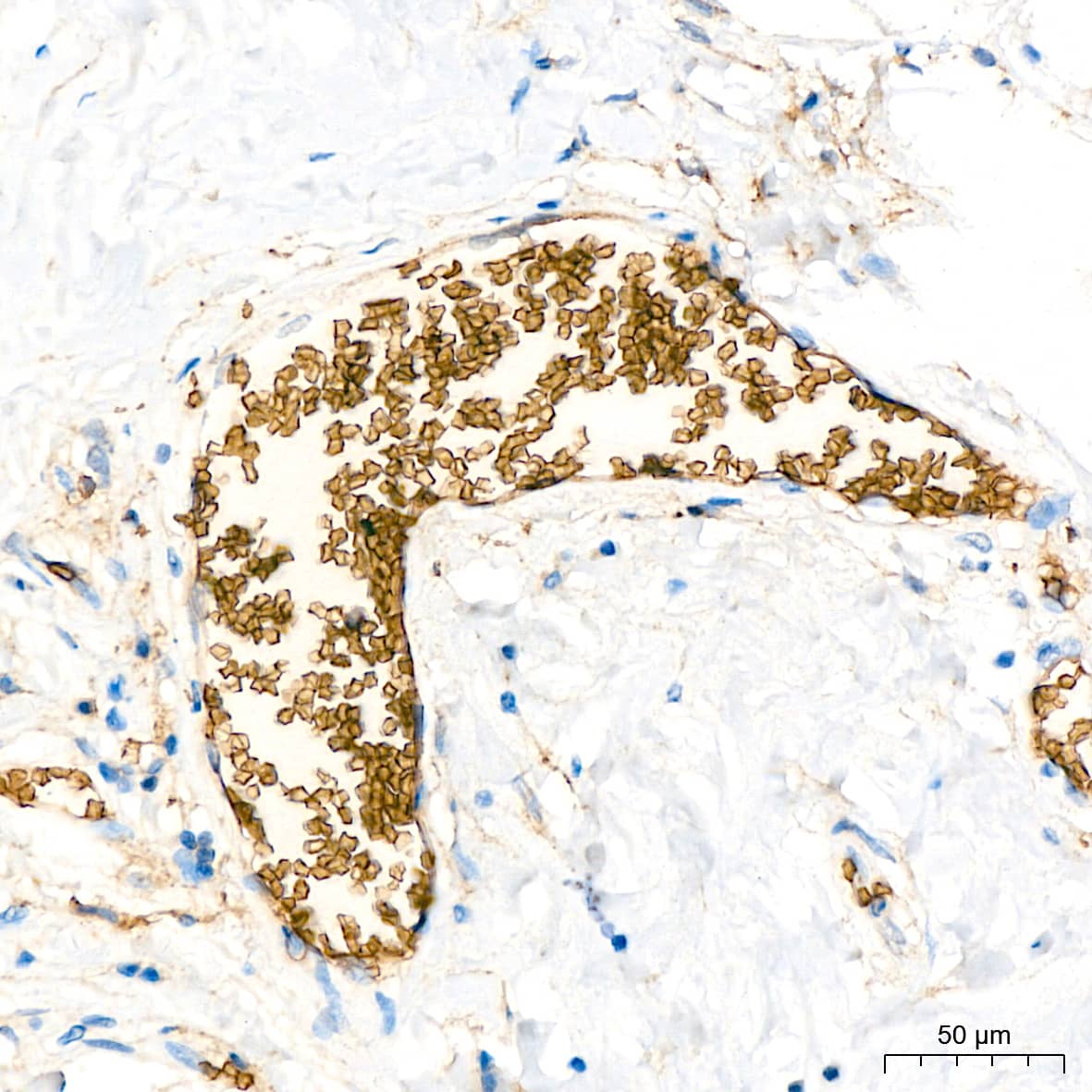 Immunohistochemistry: Glycophorin C Antibody (9K8U2) [Glycophorin C] - Immunohistochemistry analysis of paraffin-embedded Human breast tissue using Glycophorin C Rabbit mAb  at a dilution of 1:200 (40x lens). High pressure antigen retrieval performed with 0.01M Citrate Buffer(pH 6.0) prior to IHC staining.