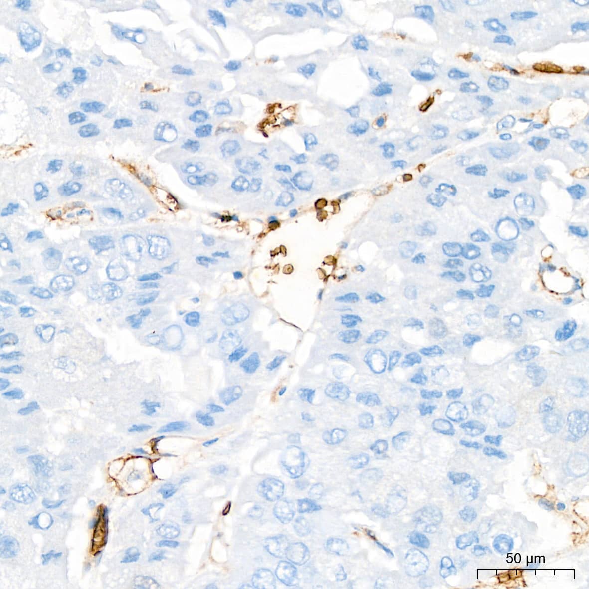 Immunohistochemistry: Glycophorin C Antibody (9K8U2) [Glycophorin C] - Immunohistochemistry analysis of paraffin-embedded Human liver cancer tissue using Glycophorin C Rabbit mAb  at a dilution of 1:200 (40x lens). High pressure antigen retrieval performed with 0.01M Citrate Buffer(pH 6.0) prior to IHC staining.