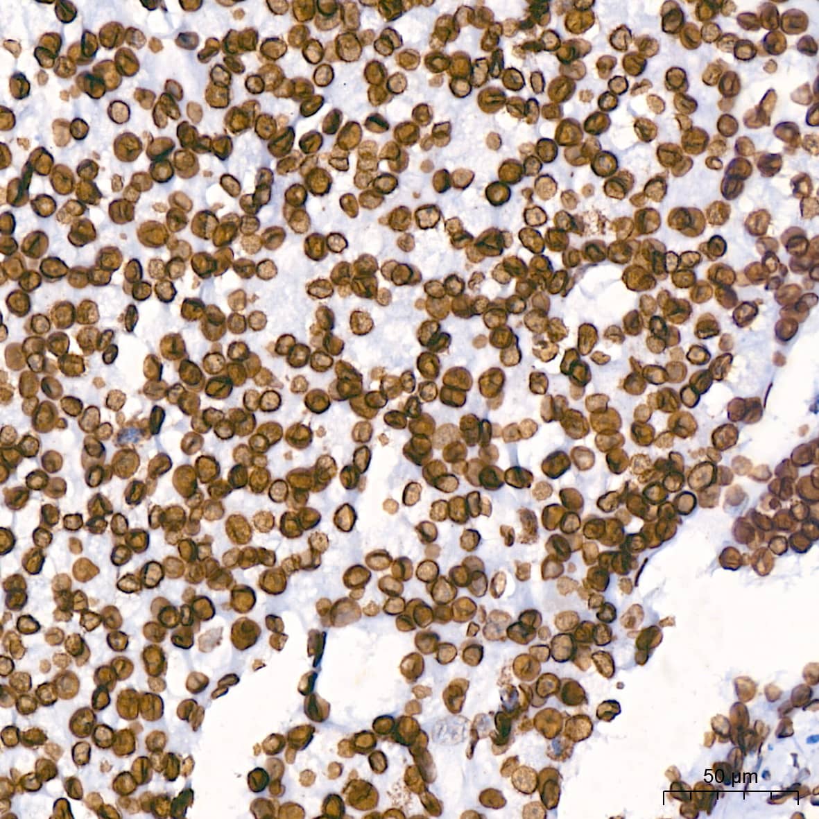 Immunohistochemistry: Lamin B1 Antibody (5H8V8) [Lamin B1] - Immunohistochemistry analysis of paraffin-embedded Human liver cancer using Lamin B1 Rabbit mAb  at dilution of 1:200 (40x lens). High pressure antigen retrieval performed with 0.01M Citrate Bufferr (pH 6.0) prior to IHC staining.