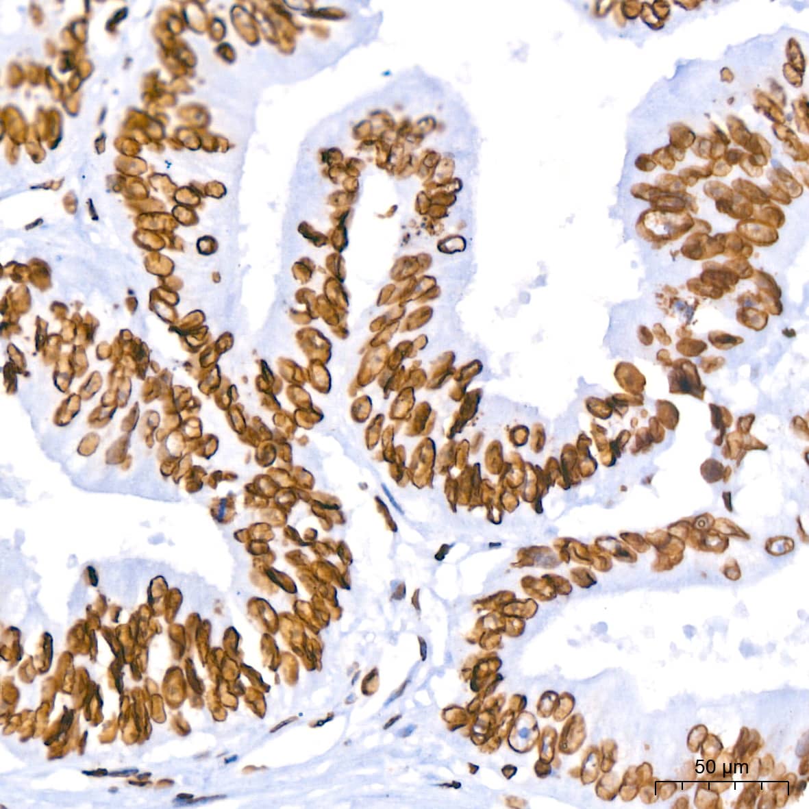 Immunohistochemistry: Lamin B1 Antibody (5H8V8) [Lamin B1] - Immunohistochemistry analysis of paraffin-embedded Human colon carcinoma using Lamin B1 Rabbit mAb  at dilution of 1:400 (40x lens). High pressure antigen retrieval performed with 0.01M Citrate Bufferr (pH 6.0) prior to IHC staining.